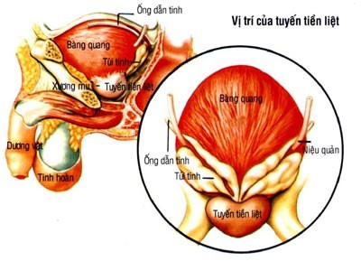 Can canh cay phong xa chua ung thu tuyen tien liet o VN-Hinh-11